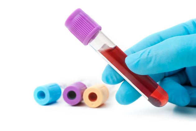 Blood Test Could Predict Return Of Breast Cancer